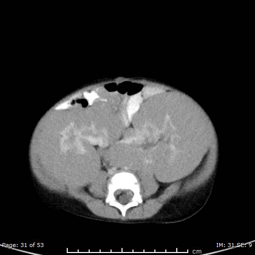 File:Nephroblastomatosis (Radiopaedia 41934-44935 A 31).jpg