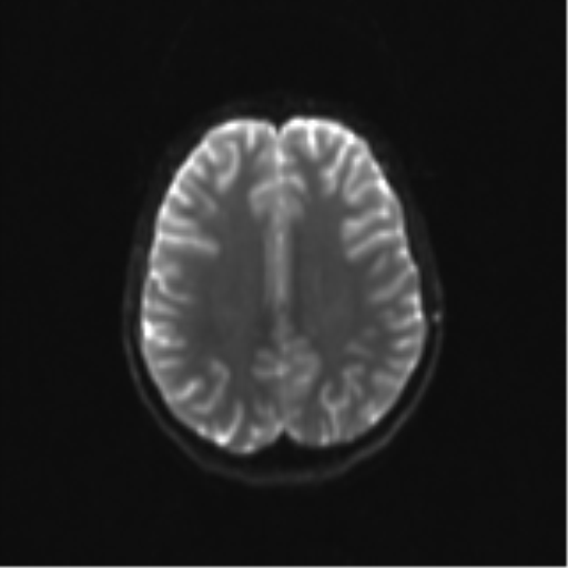 Neurenteric cyst (Radiopaedia 58641-65837 Axial DWI 25).png