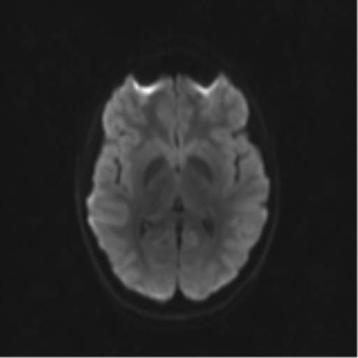 Neurenteric cyst (Radiopaedia 58641-65837 Axial DWI 53).png