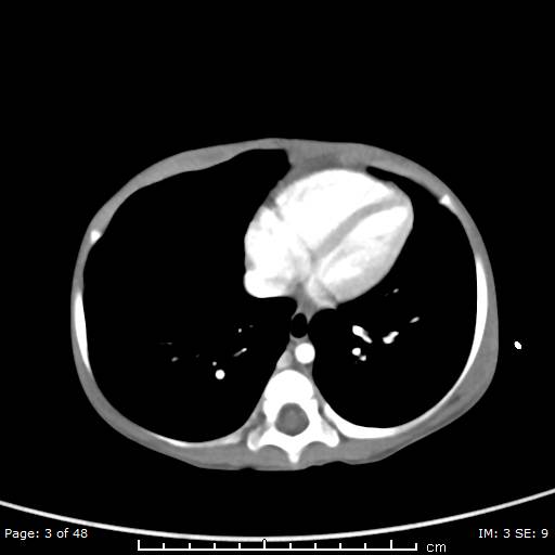 File:Neuroblastoma (Radiopaedia 41472-44355 A 3).jpg