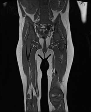 File:Neuroblastoma with bone metastases (Radiopaedia 67080-76414 Coronal T1 14).jpg