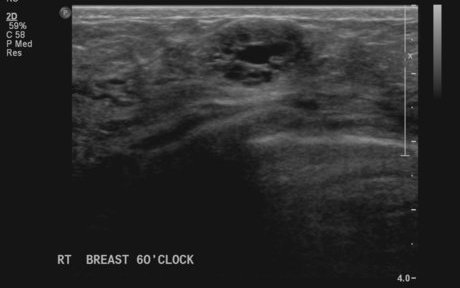 File:Neurofibromatosis of breast (Radiopaedia 5921-7462 E 1).jpg