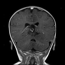 File:Neurofibromatosis type 1 (Radiopaedia 30089-30671 Coronal T1 C+ 19).jpg