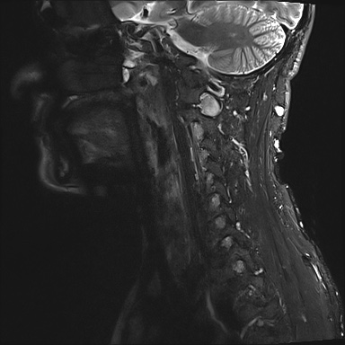 File:Neurofibromatosis type 1 (Radiopaedia 80355-93740 Sagittal STIR 9).jpg