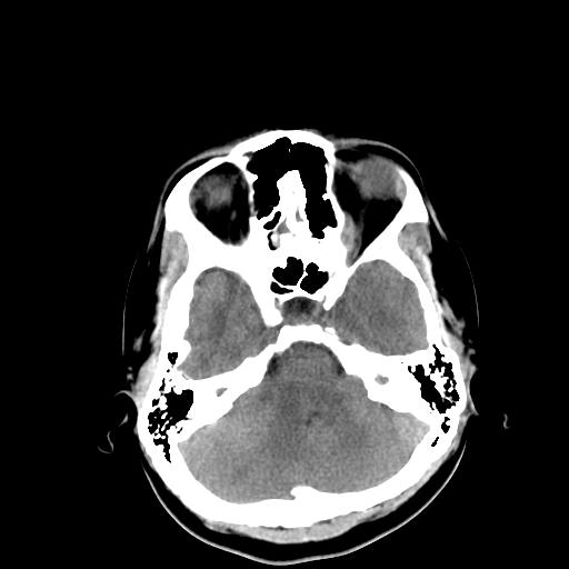 File:Neurofibromatosis type 2 (Radiopaedia 25389-25637 Axial non-contrast 6).jpg