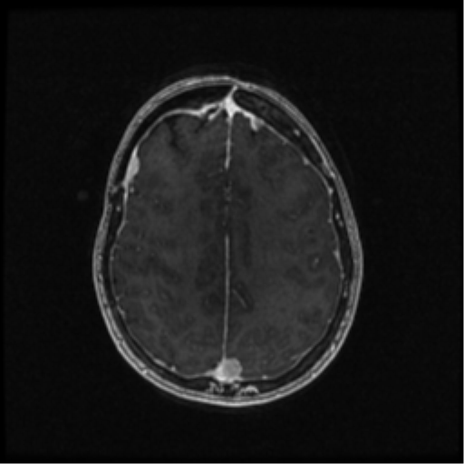 Neurofibromatosis type 2 (Radiopaedia 45229-49244 Axial T1 C+ 84).png