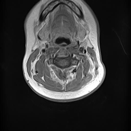 File:Neurofibromatosis type 2 (Radiopaedia 66211-75403 Axial T1 C+ 9).jpg
