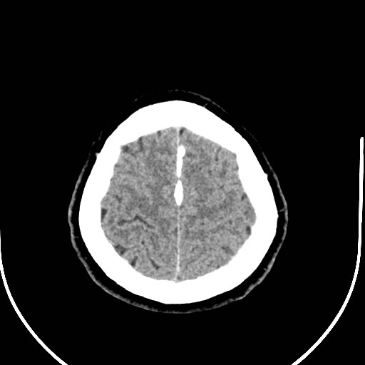 Neurofibromatosis type 2 (Radiopaedia 79097-92047 Axial non-contrast 53).jpg