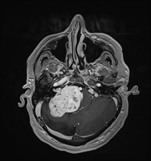 Neurofibromatosis type 2 (Radiopaedia 79097-92049 Axial T1 C+ 53).jpg