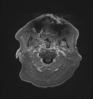 Neurofibromatosis type 2 (Radiopaedia 79097-92049 Axial T1 C+ 8).jpg