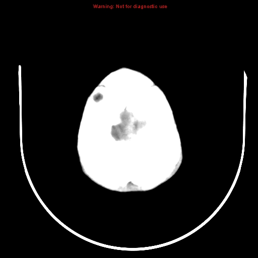 File:Neurofibromatosis type 2 (Radiopaedia 8953-9732 C 29).jpg
