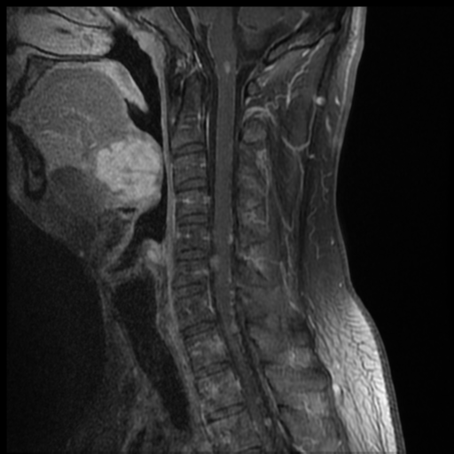 File:Neurofibromatosis type 2 (spinal manifestations) (Radiopaedia 53943-60070 G 6).png