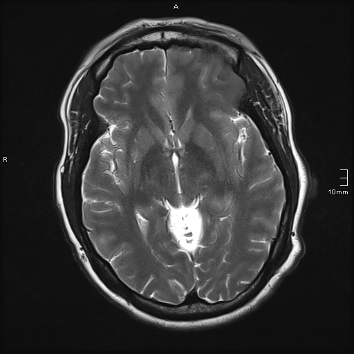 File:Neurotoxoplasmosis - concentric target sign (Radiopaedia 70644-80784 Axial T2 10).jpg