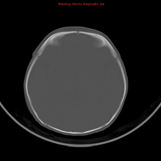 File:Non-accidental injury - bilateral subdural with acute blood (Radiopaedia 10236-10765 Axial bone window 11).jpg