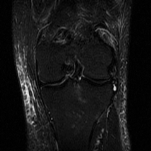 File:Non-displaced patella fracture (Radiopaedia 15932-15582 Coronal STIR 14).jpg
