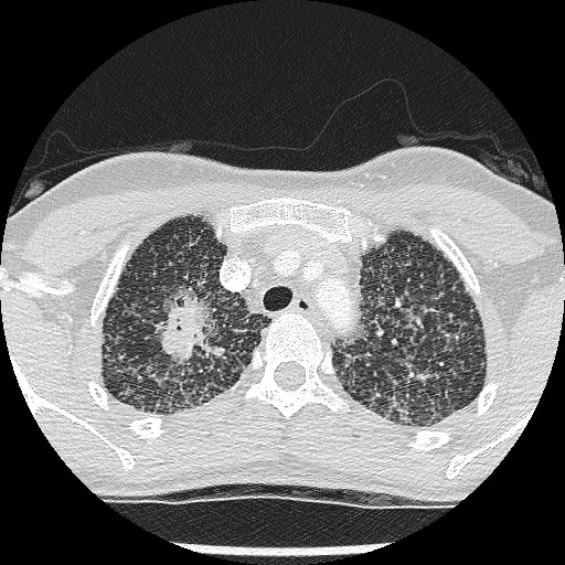 File:Non-small cell lung cancer with miliary metastases (Radiopaedia 23995-24193 Axial lung window 7).jpg
