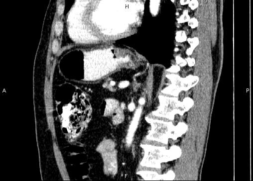 Non-syndromic pancreatic endocrine tumor (Radiopaedia 86958-103178 E 62).jpg