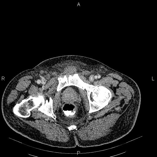 File:Non Hodgkin lymphoma in a patient with ankylosing spondylitis (Radiopaedia 84323-99621 B 63).jpg