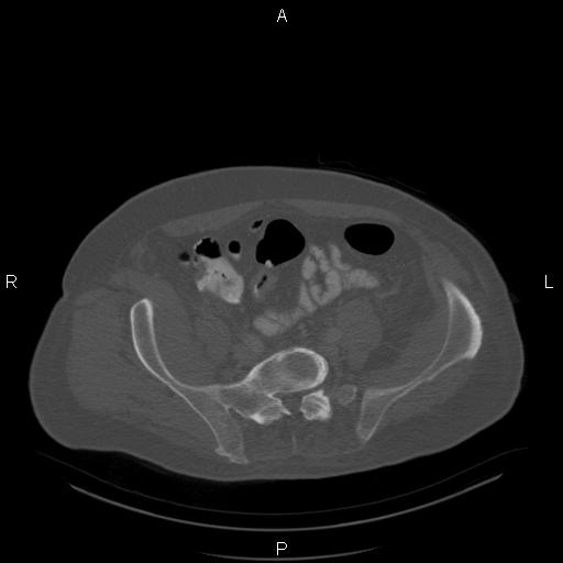 Non Hodgkin lymphoma in a patient with ankylosing spondylitis (Radiopaedia 84323-99624 Axial bone window 52).jpg