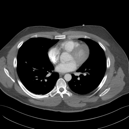 File:Normal CTA thorax (non ECG gated) (Radiopaedia 41750-44704 A 57).png