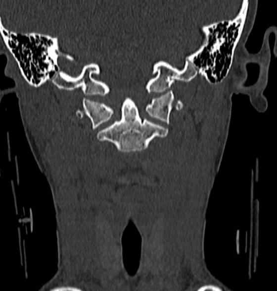File:Normal CT cervical spine - 12-year-old (Radiopaedia 55352-61775 Coronal bone window 61).jpg