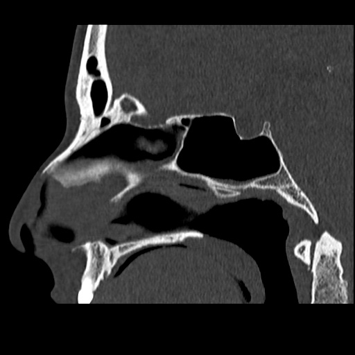 Normal CT paranasal sinuses (Radiopaedia 42286-45390 Sagittal bone window 50).jpg