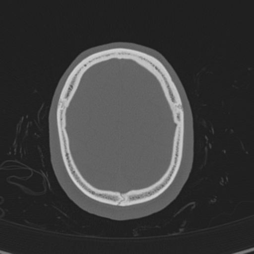 Normal CT skull (Radiopaedia 40798-43459 A 134).png