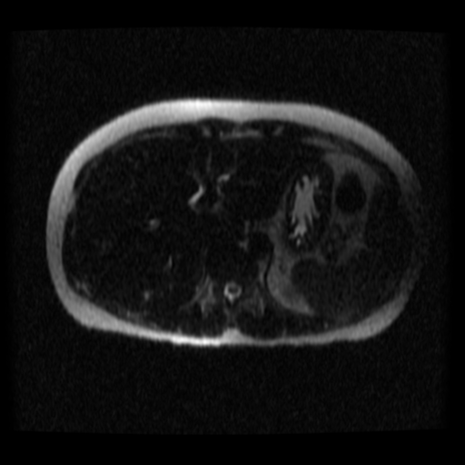 File:Normal MRCP (Radiopaedia 41966-44978 Axial T2 thins 28).png