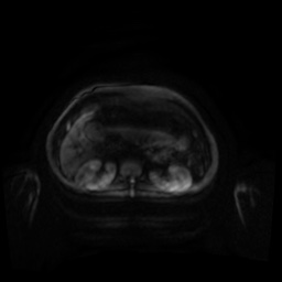 Normal MRI abdomen in pregnancy (Radiopaedia 88001-104541 Axial DWI 122).jpg