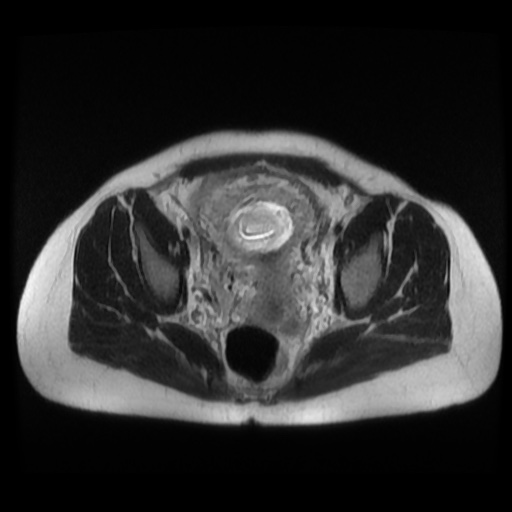Normal MRI abdomen in pregnancy (Radiopaedia 88003-104546 Axial T2 41).jpg