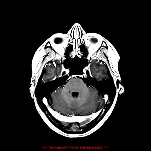 Normal adult brain MRI (non-enhanced and contrast-enhanced) (Radiopaedia 75262-86379 Axial T1 C+ 74).jpg