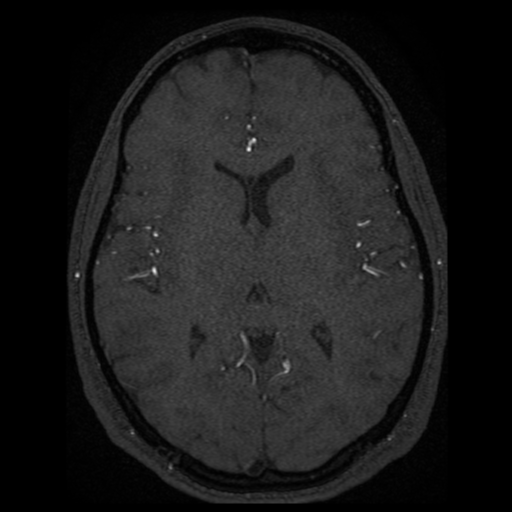 Normal brain MRA (Radiopaedia 41046-43793 Axial MRA 17).png