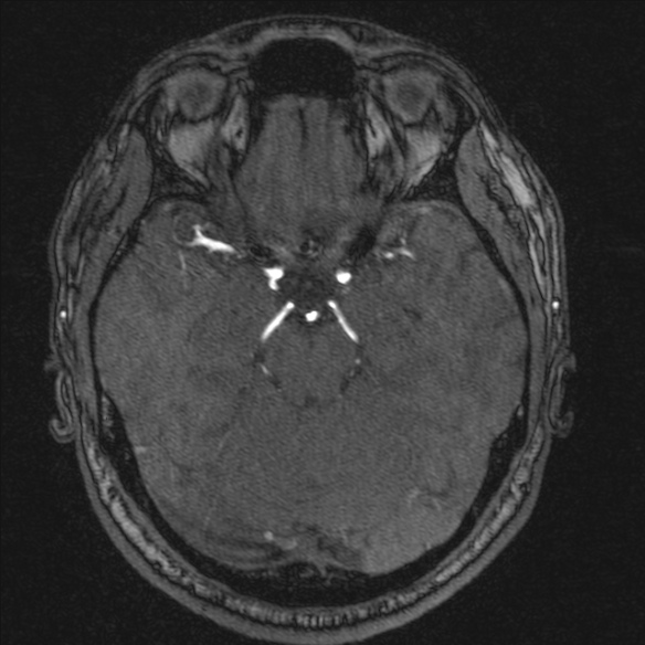 Normal brain MRI including MRA (Radiopaedia 48748-53763 Axial MRA 76).jpg