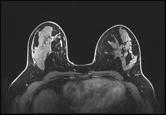 Normal breast MRI - dense breasts (Radiopaedia 80454-93850 C 106).jpg