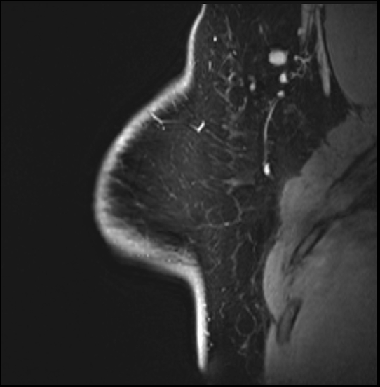 Normal breast MRI - dense breasts (Radiopaedia 80454-93850 I 46).jpg