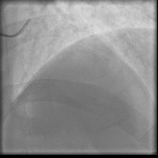 Normal coronary angiogram (DSA) (Radiopaedia 63081-71571 E 10).jpg