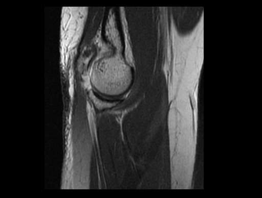 File:Normal elbow arthrograms (Radiopaedia 75550-86805 Sagittal PD 28).jpg