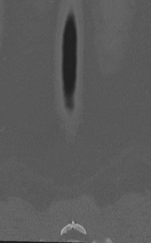 Normal lumbar spine CT (Radiopaedia 46533-50986 Coronal bone window 82).png