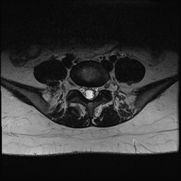 File:Normal lumbar spine MRI- 3 T (Radiopaedia 53280-59250 Axial T2 26).jpg