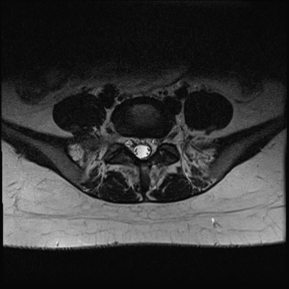 File:Normal lumbar spine MRI- 3 T (Radiopaedia 53280-59250 Axial T2 27).jpg