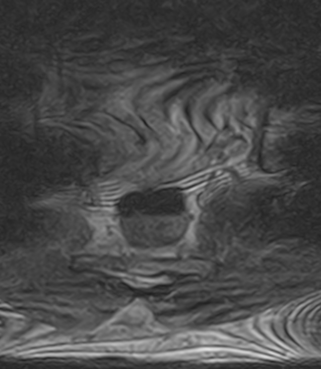 Normal lumbar spine MRI - low-field MRI scanner (Radiopaedia 40976-43699 Axial T2 109).jpg