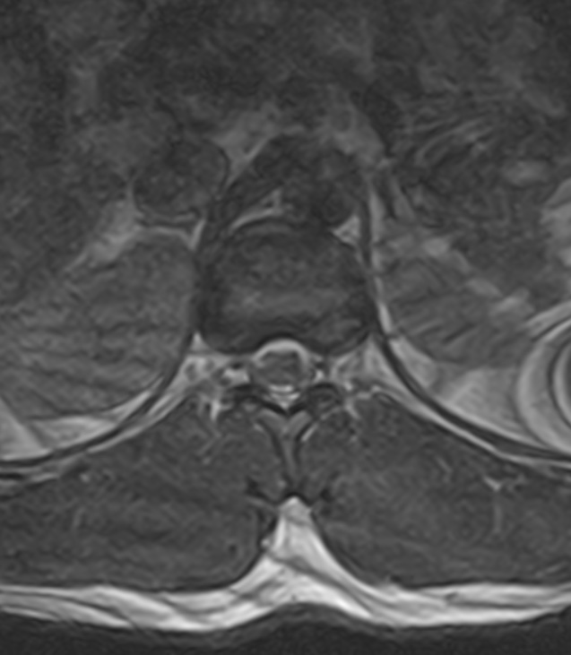 Normal lumbar spine MRI - low-field MRI scanner (Radiopaedia 40976-43699 Axial T2 6).jpg