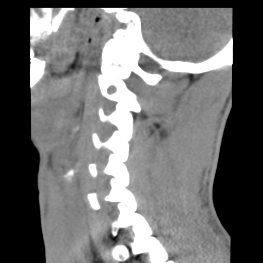 File:Normal trauma cervical spine (Radiopaedia 41017-43760 B 21).png