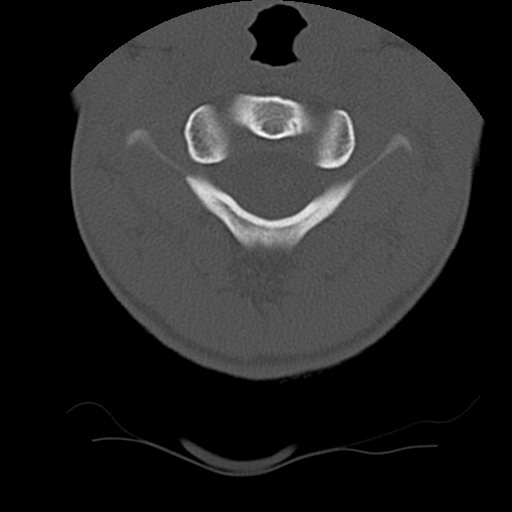 Normal trauma spine imaging (age 16) (Radiopaedia 45335-49358 Axial bone window 14).jpg