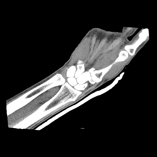 Normal wrist CT (Radiopaedia 41425-44297 Axial non-contrast 1).png