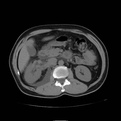 File:Obstructed kidney with perinephric urinoma (Radiopaedia 26889-27066 Axial non-contrast 18).jpg