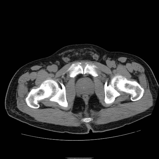 File:Obstructed kidney with perinephric urinoma (Radiopaedia 26889-27066 Axial non-contrast 64).jpg