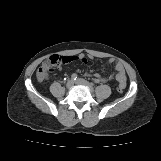 File:Obstructed kidney with perinephric urinoma (Radiopaedia 26889-27067 Axial non-contrast 27).jpg