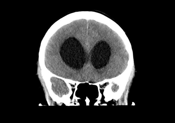 File:Obstructive hydrocephalus (Radiopaedia 30453-31119 Coronal non-contrast 13).jpg