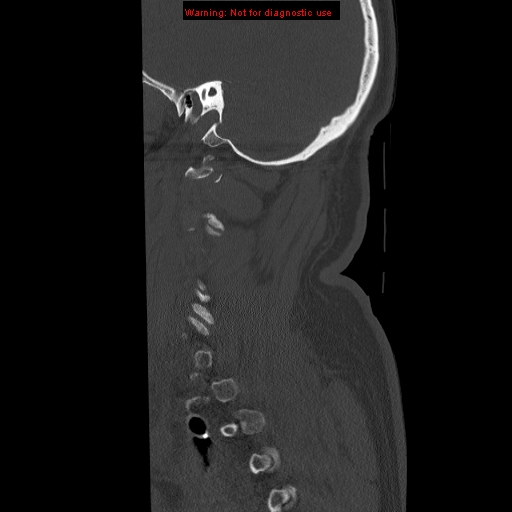 File:Occipital condyle fracture (Radiopaedia 18366-18208 Sagittal bone window 3).jpg